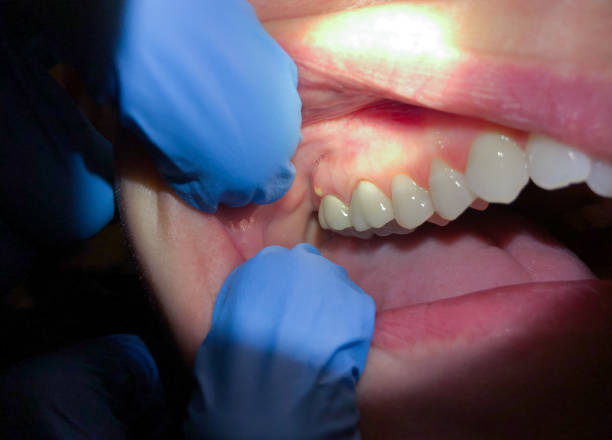 Best Emergency Dental Care for Sports Injuries in Brunswick, GA